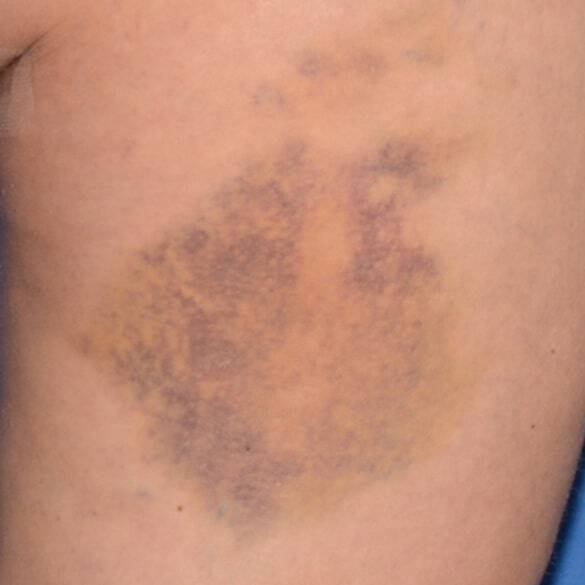 Day 8 with Replasty Age Recovery Body