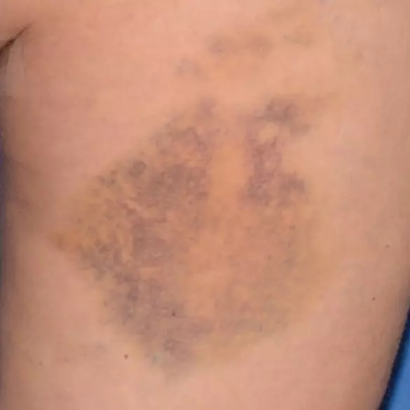 Day 8 with Replasty Age Recovery Body
