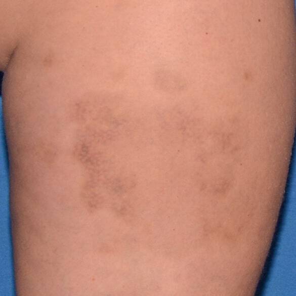 Day 28 with reference cream