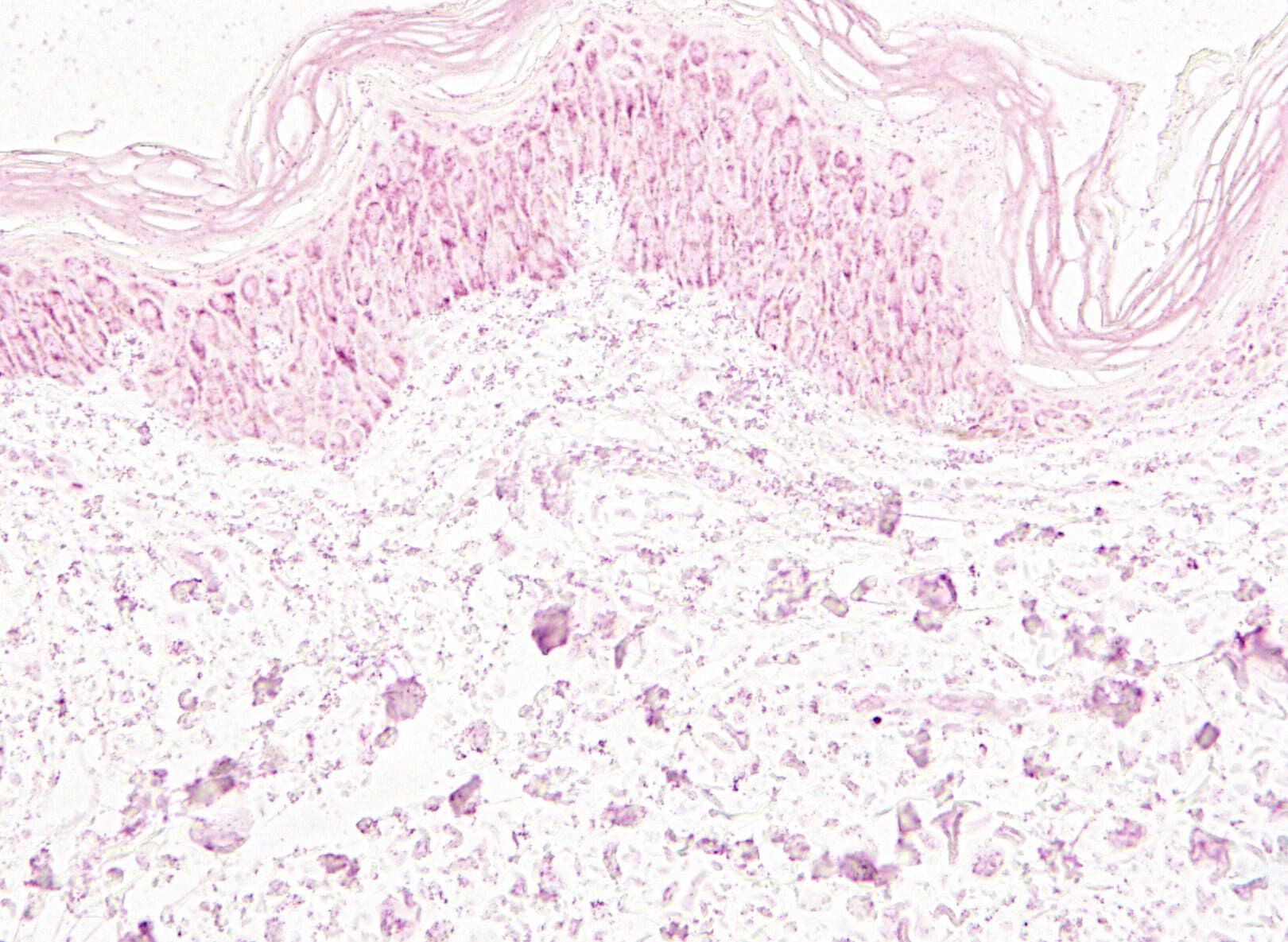 Scientific visualization of skin glycation, highlighting areas of collagen damage in dark pink.